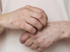 В Воронежской области выросла заболеваемость ветрянкой