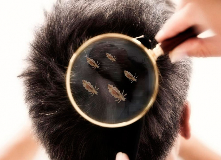 В Воронежской области в 2022 году зафиксировали 122 случая педикулёза